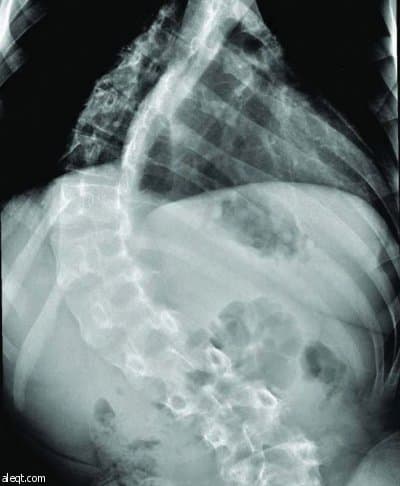 نجاح علاج مريض أصيب بالشلل نتيجة انحراف العمود الفقري