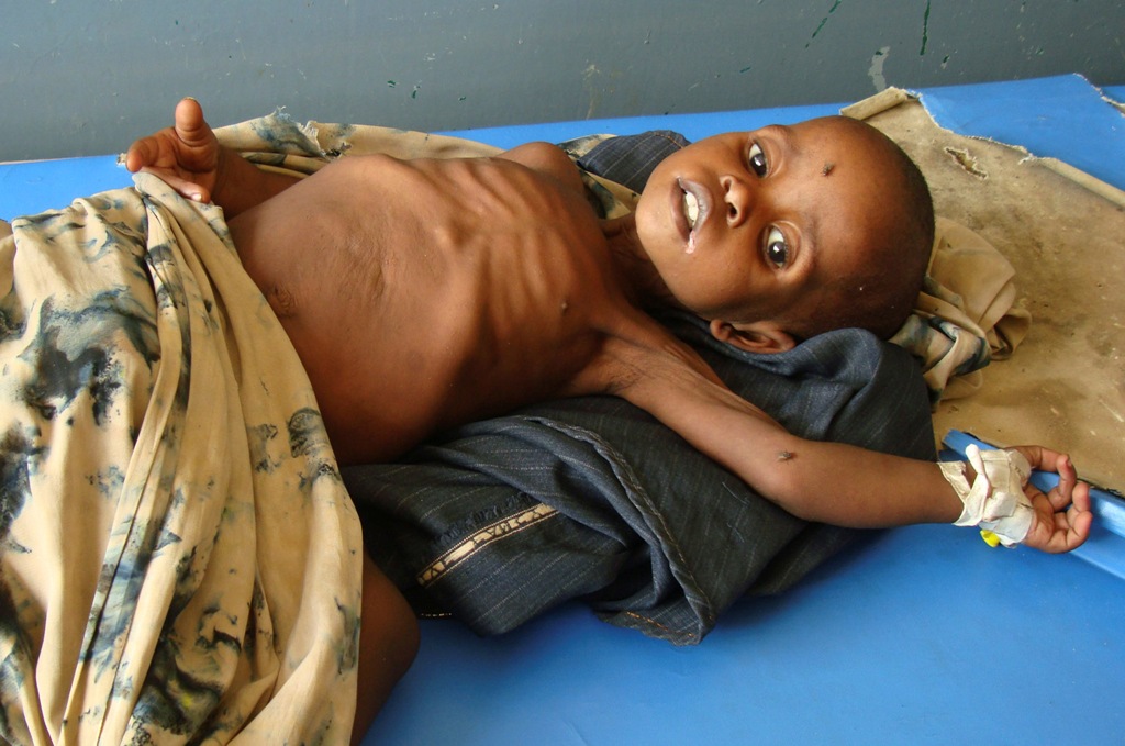 صور لأطفال الصومال تكشف عن أعلى مستويات سوء التغذية في