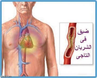 تطبيق الطب الوقائي كلما أمكن يمثل فائدة أكثر من الطب العلاجي خاصة في أمراض القلب