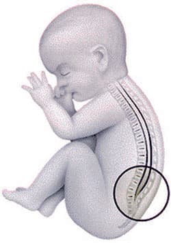 الصلب المشقوق .. 3 أسباب للمرض و5 أعراض تصيب الأطفال