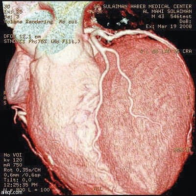 د. سعادة: جهاز CT-Scan الجديد يغني عن القسطرة التشخيصية ويقوم بتصوير شرايين القلب دون ألم أو تخدير