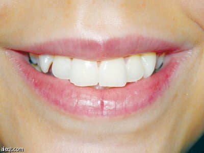 تقنية الوجوه الخزفية تساعد على تصحيح الأسنان في أقل من أسبوعين