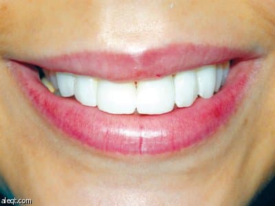 تقنية الوجوه الخزفية تساعد على تصحيح الأسنان في أقل من أسبوعين