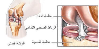 الرباط الصليبي يتم علاجه وفق التقنيات الحديثة بالمنظار