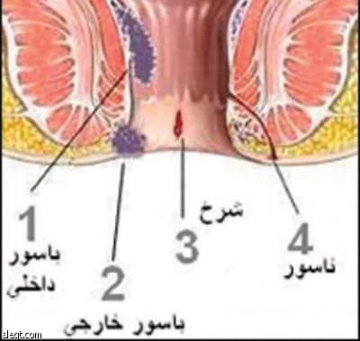 الشرخ الشرجي من عمليات اليوم الواحد والتقييم السليم ضروري جداً لسرعة تحسن الحالة