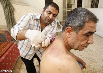 فلسطيني يجري "الحجامة" داخل عيادة في جنوب قطاع غزة.