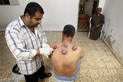 فلسطيني يجري "الحجامة" داخل عيادة في جنوب قطاع غزة.