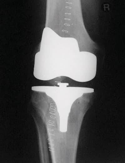 عملية استبدال المفصل الصناعي هي الأكثر أمانا وفاعلية للتخلص من الآلام