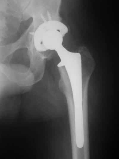 عملية استبدال المفصل الصناعي هي الأكثر أمانا وفاعلية للتخلص من الآلام