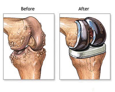 عملية استبدال المفصل الصناعي هي الأكثر أمانا وفاعلية للتخلص من الآلام