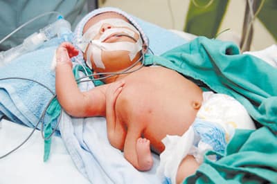 نجاح فصل توأم «طفيلي» سعودي في مدينة الملك عبد العزيز الطبية