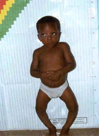 فيتامين (د) ... وأثره في العظام