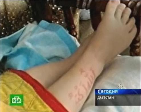 آيات وأحاديث تظهر وتختفي على جلد رضيع روسي في داغستان