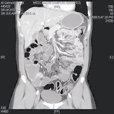 جهاز CARDIAC CT – SCAN يكتشف الجلطات الرئوية والقلبية مبكرا