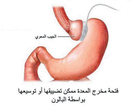 عملية تحزيم المعدة بالمنظار تتم ببساطة ودون أي قطع أو تدبيس