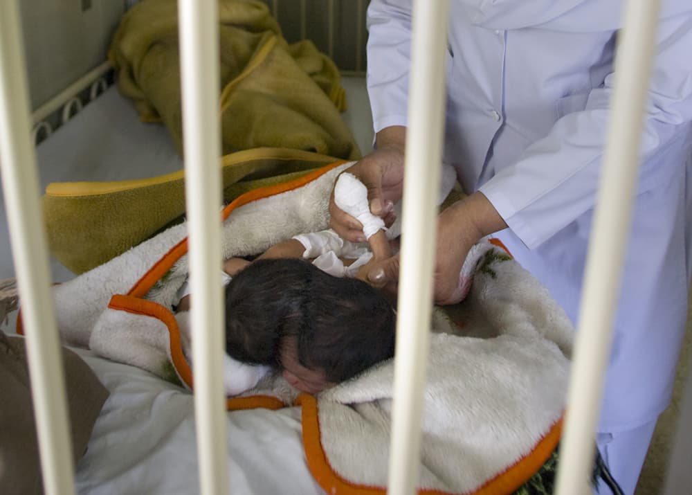 توأمتين ملتصقين تتلقيا العلاج الطبي داخل مستشفى في إسلام أباد قبيل إجراء عملية جراحية لفصلهما يقوم بها أطباء من معهد باكستان للع