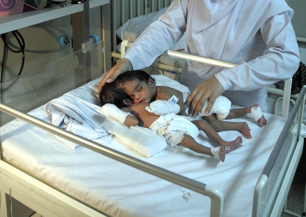 توأمتين ملتصقين تتلقيا العلاج الطبي داخل مستشفى في إسلام أباد قبيل إجراء عملية جراحية لفصلهما يقوم بها أطباء من معهد باكستان للع