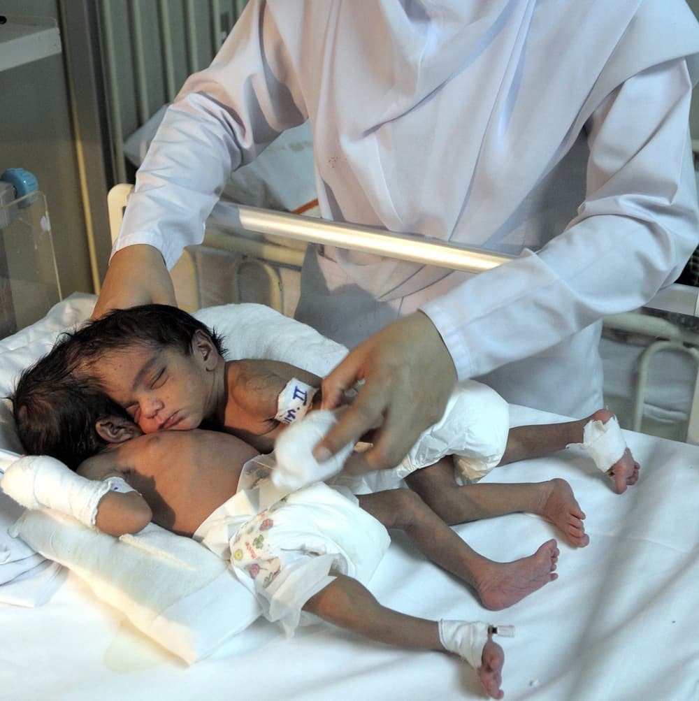 توأمتين ملتصقين تتلقيا العلاج الطبي داخل مستشفى في إسلام أباد قبيل إجراء عملية جراحية لفصلهما يقوم بها أطباء من معهد باكستان للع