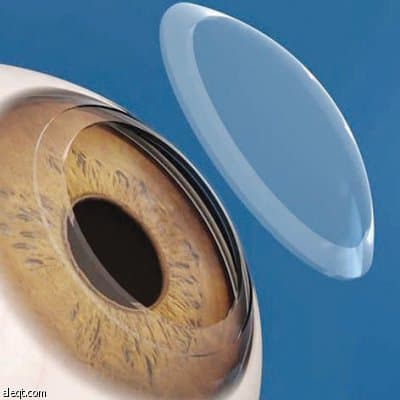 زراعة العدسات الحل البديل لمن لا يناسبه تصحيح النظر بالليزك