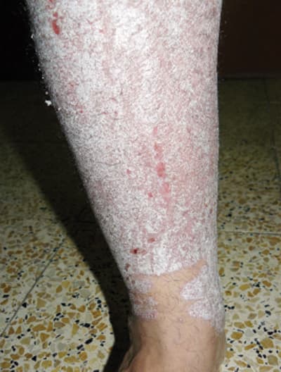 متعافون من «الصدفية» يستعرضون طرق علاجهم عبر «الشبكة العنكبوتية»