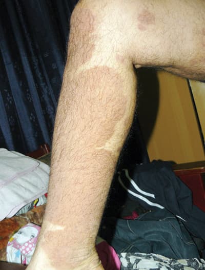 متعافون من «الصدفية» يستعرضون طرق علاجهم عبر «الشبكة العنكبوتية»