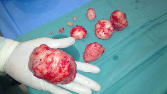 مستشفى قوى الأمن في الدمام ينجح في استئصال أورام عجزت مستشفيات اخرى عنها