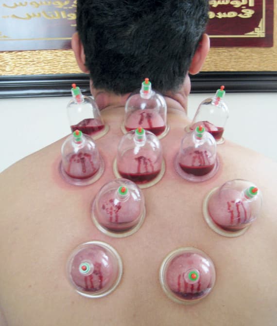 «الصحة» تشترط أماكن «حجامة» خاصة للنساء منفصلة عن الرجال لمنح التراخيص