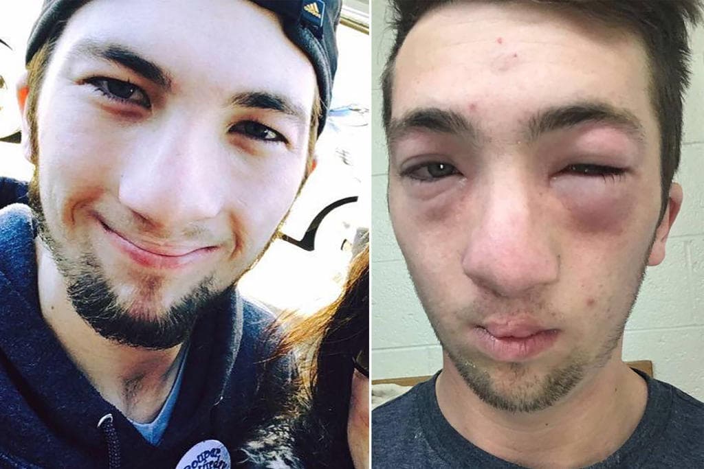 حساسية المكسرات .. الفول السوداني ينقلب إلى خطر مميت أحيانا