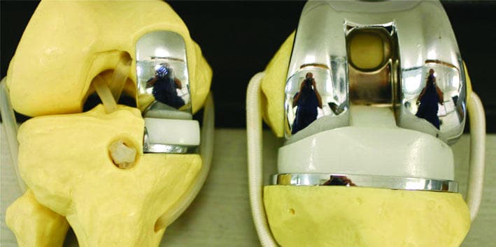 لأول مرة .. ركبة صناعية عن طريق طباعة الخلايا الحية