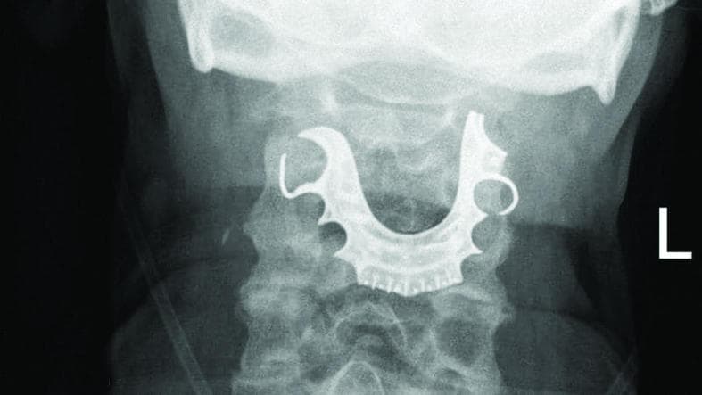 فضيحة طبية .. طاقم أسنان علق في حلقه إثر خضوعه لجراحة في بريطانيا