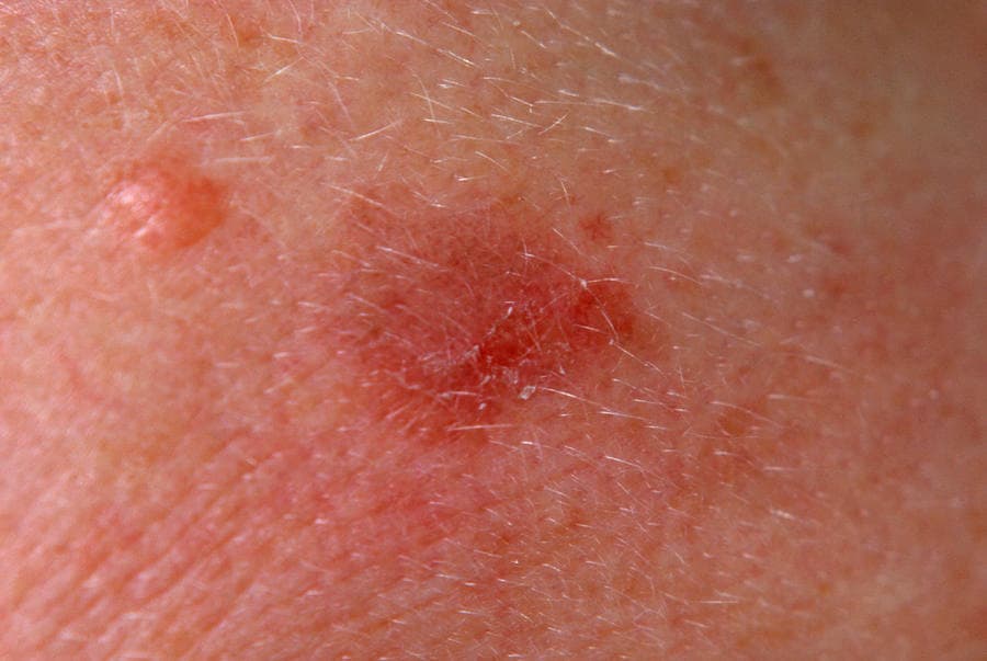 ما أسباب ظهور البقع الحمراء على الجلد وماخطورتها؟