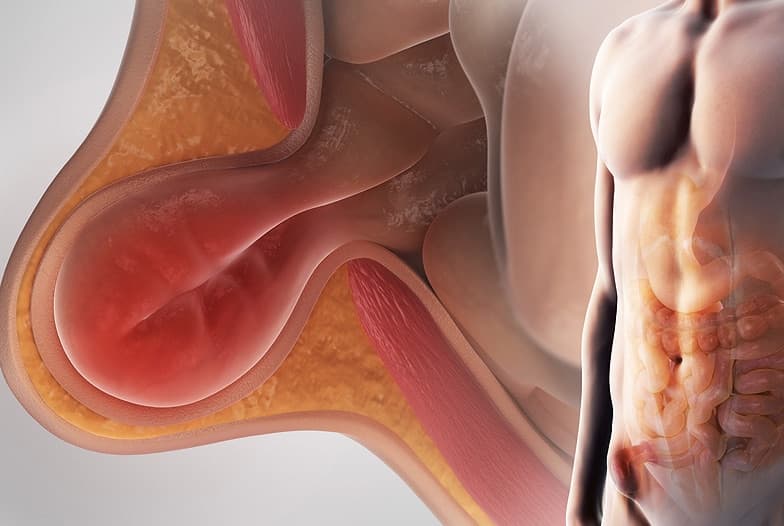 الفتق من الأمراض القديمة وتطورات علاجه