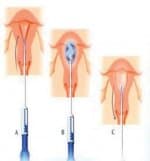 علاج النزيف الرحمي بالكـي بدلاً مـن استئصاله يحقق نسب نجاح تصل إلى 90 %