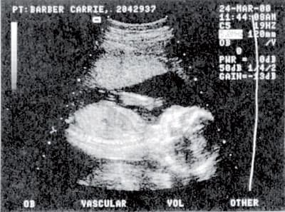 فحص دم يكشف جنس الجنين بعد 7 أسابيع من الحمل