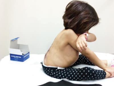 استشاري سعودي يقود فريقا طبيا لإزالة تحدب خطير في العمود الفقري