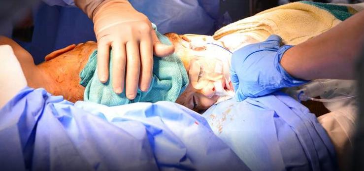 نجاح عملية فصل التوأم السيامي السوري "تقى ويقين"