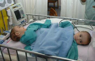 نجاح عملية فصل التوأم السيامي المصري حسن ومحمود