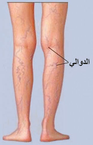فشل الصمامات يسبب الإصابة بدوالي الساقين