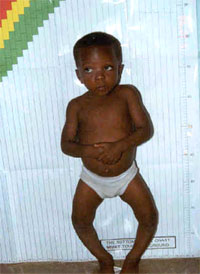 فيتامين (د) ... وأثره في العظام