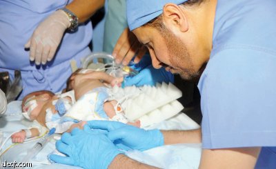 نجاح فصل السيامي العراقي «زينب ورقية» في مدينة الملك عبد العزيز الطبية