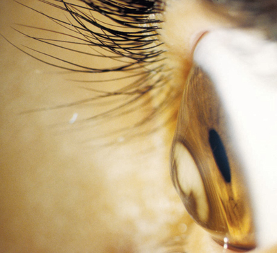 العدسات اللاصقة الصلبة خيار مناسب للقرنية المخروطية.. والجراحة حل أخير