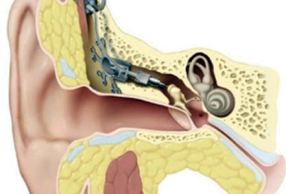 التهابات الأذن المتكررة قد تسبب الصمم والكشف يتم بالمنظار