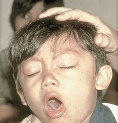 «الصحة العالمية»: السل المقاوم للأدوية المتعددة في ازدياد