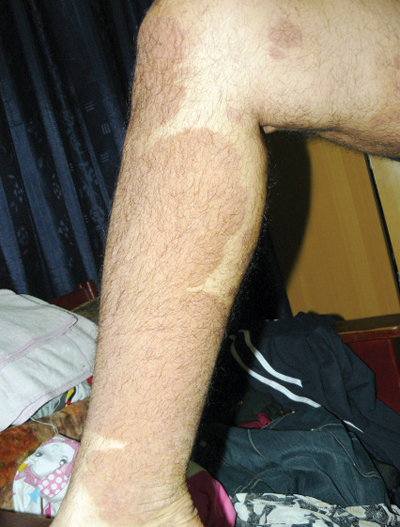 متعافون من «الصدفية» يستعرضون طرق علاجهم عبر «الشبكة العنكبوتية»