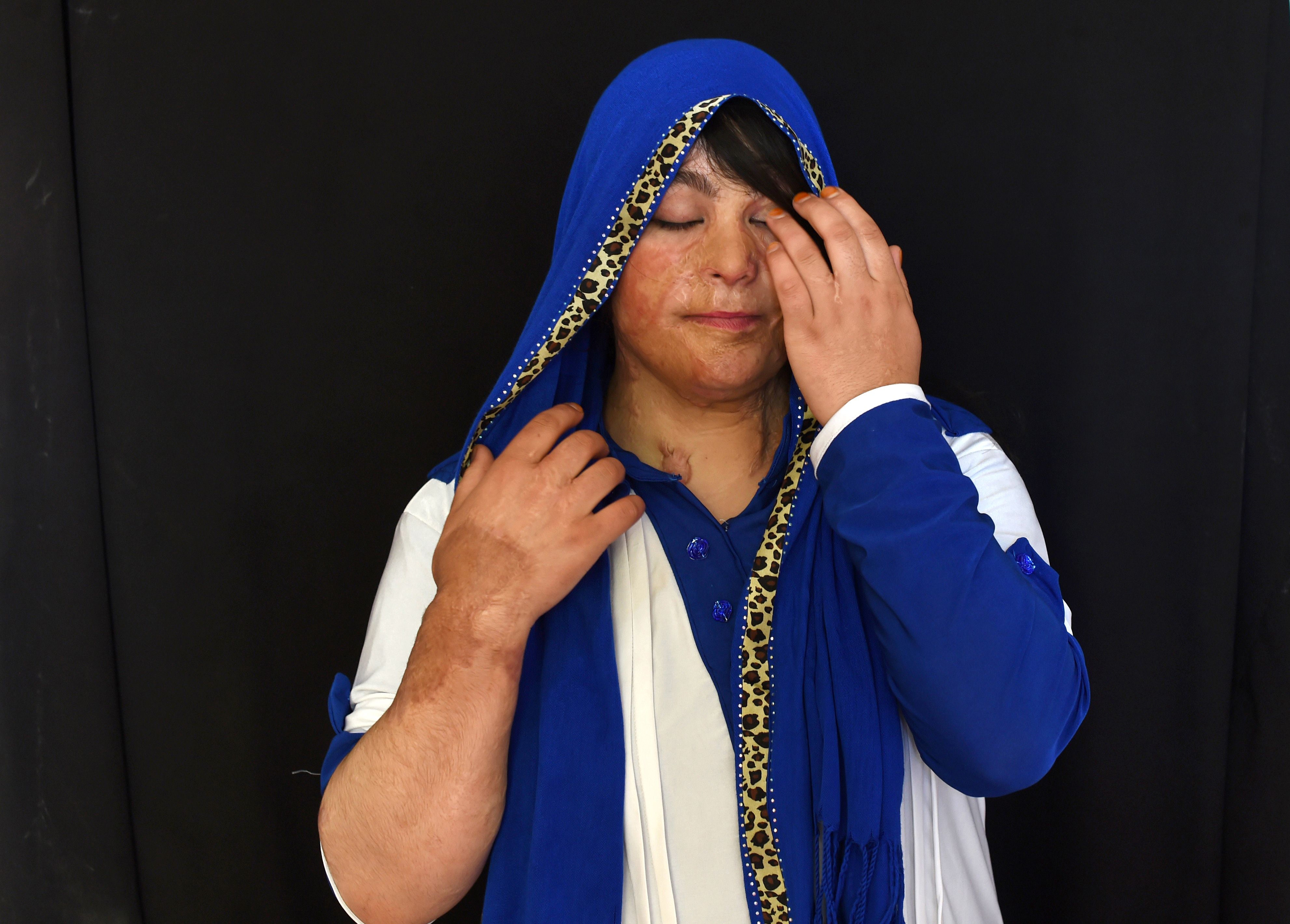 "ممتاز" الأفغانية تعيش وسط الخوف المتواصل بعد تشويه وجهها بالحمض