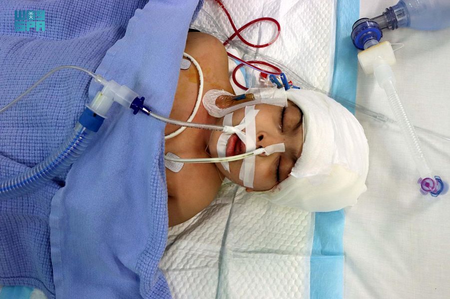 بعد عملية معقدة استغرقت 17 ساعة .. نجاح فصل التوأم السيامي المصري سلمى وسارة