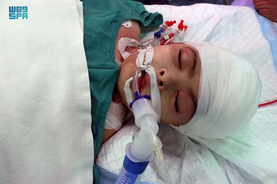 بعد عملية معقدة استغرقت 17 ساعة .. نجاح فصل التوأم السيامي المصري سلمى وسارة