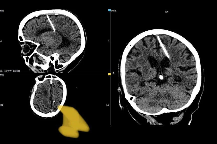أطباء يعثرون على إبرة في دماغ امرأة منذ 80 عاما