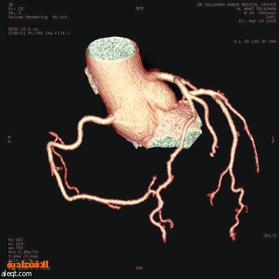 د. سعادة: جهاز CT-Scan الجديد يغني عن القسطرة التشخيصية ويقوم بتصوير شرايين القلب دون ألم أو تخدير