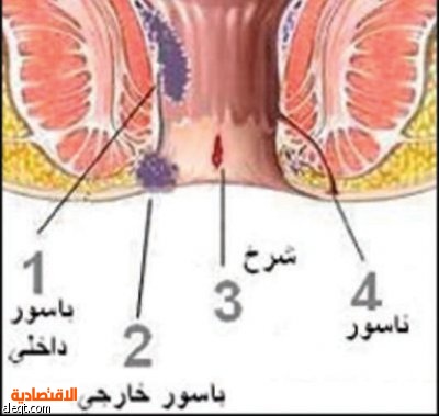 الشرخ الشرجي من عمليات اليوم الواحد والتقييم السليم ضروري جدا لسرعة تحسن الحالة صحيفة الاقتصادية